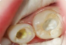 Методы лечения пульпита временных зубов